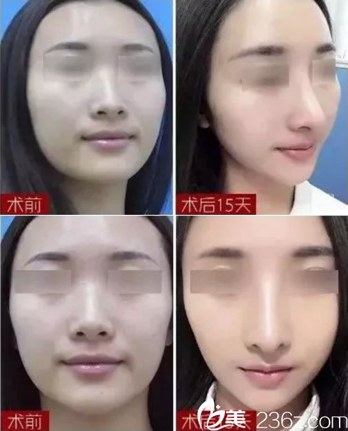 徐建國做鼻綜合15天前后<span style=