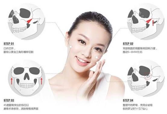 邊圣洙院長分享手術過程