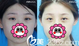 雙眼皮案例 雙眼皮案例