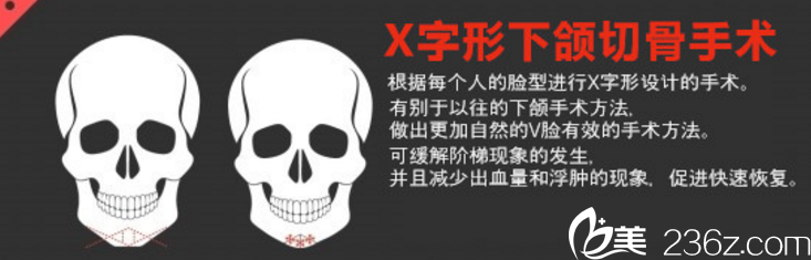 X字形下頜切骨手術(shù)韓國(guó)女神整形醫(yī)院 X字形下頜切骨手術(shù)韓國(guó)女神整形醫(yī)院