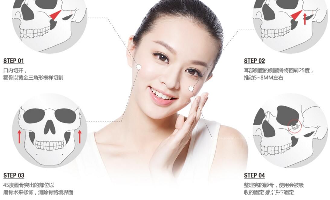 黃金三角形切骨和25度回轉(zhuǎn)術(shù) 黃金三角形切骨和25度回轉(zhuǎn)術(shù)