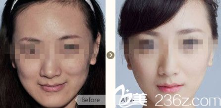 瘦臉除皺注射對比圖