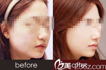 瘦臉除皺注射瘦臉前后對比