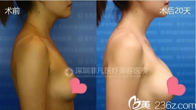 找深圳非凡楊偉杰做的隆胸20天側(cè)面效果