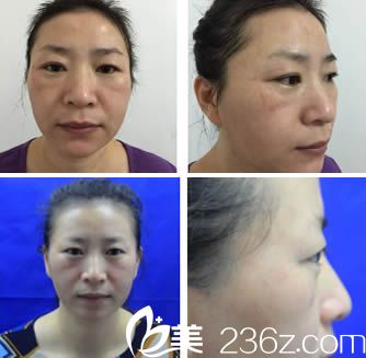 覃建云醫(yī)師微針美塑<span style=