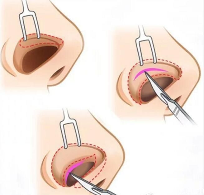 非切開式隆鼻手術封閉式隆鼻方法