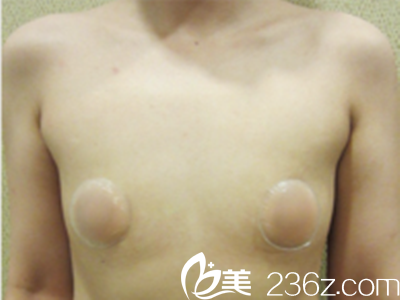 韓國(guó)世大特整形醫(yī)院做假體隆胸好嗎？姜鍊雄院長(zhǎng)假體隆胸真人案例！