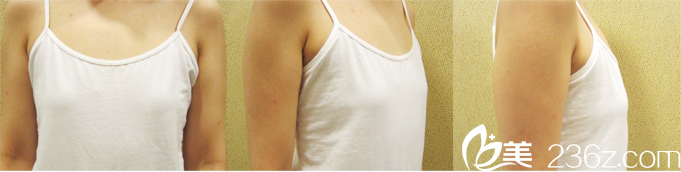 START醫(yī)院真人案例術(shù)前拍照 START醫(yī)院真人案例術(shù)前拍照