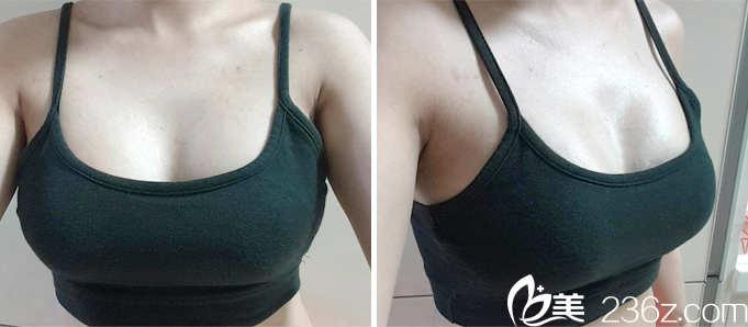 世大特START醫(yī)院胸部整形案例術(shù)后2周恢復(fù) 世大特START醫(yī)院胸部整形案例術(shù)后2周恢復(fù)