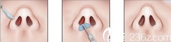 封閉式隆鼻方法