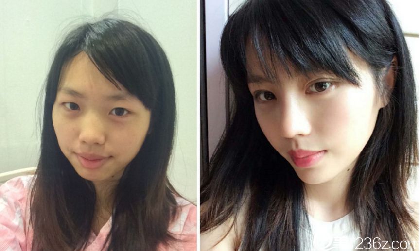 韓國美自人整形醫(yī)院鼻整形真人案例