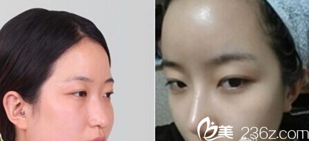 韓國美自人整形醫(yī)院金燦棕院長做鼻子真人案例