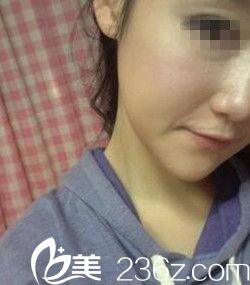 駐馬店美林苑改臉型：嫩牛五方臉逆襲網(wǎng)紅臉的親身經(jīng)歷