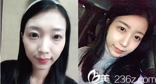 徐東皖院長(zhǎng)面部自體脂肪填充案例對(duì)比