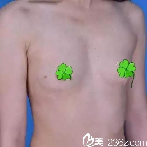 吳世元做硅膠假體隆胸術(shù)前效果 吳世元做硅膠假體隆胸術(shù)前效果