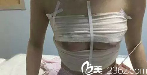 韓國吳世元整形外科醫(yī)院吳世元做硅膠假體隆胸案例 韓國吳世元整形外科醫(yī)院吳世元做硅膠假體隆胸案例