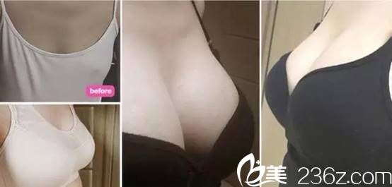 韓國吳世元整形外科醫(yī)院吳世元做硅膠假體隆胸圖 韓國吳世元整形外科醫(yī)院吳世元做硅膠假體隆胸圖