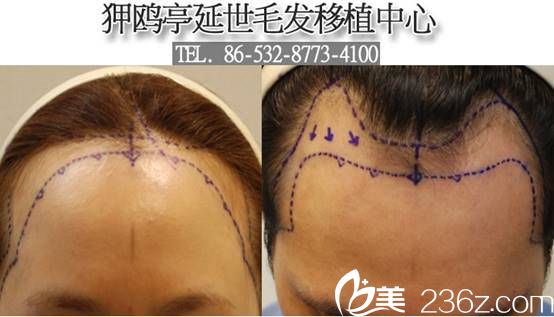 韓國(guó)狎鷗亭延世醫(yī)院毛發(fā)移植發(fā)際線(xiàn)移植
