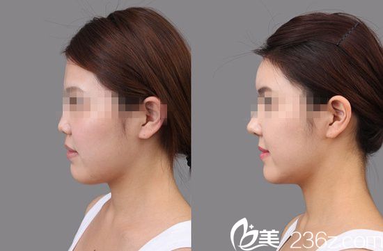 金基出院長隆鼻前后對比圖