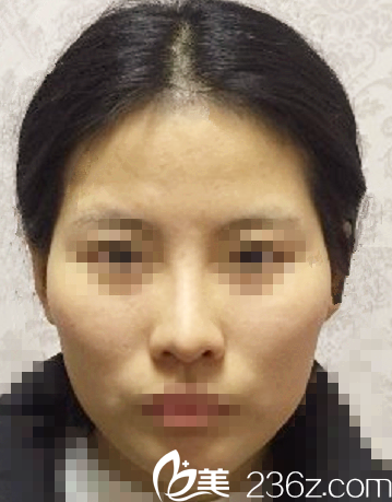 自體脂肪填充全臉術(shù)前照 自體脂肪填充全臉術(shù)前照
