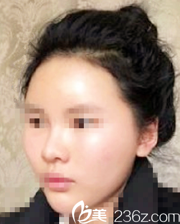 延世plus醫(yī)院自體脂肪填充面部術(shù)后第三天 延世plus醫(yī)院自體脂肪填充面部術(shù)后第三天