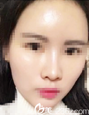 術(shù)后一周自體脂肪填充全臉 術(shù)后一周自體脂肪填充全臉