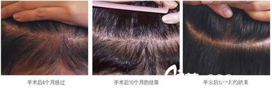 韓國(guó)狎鷗亭延世醫(yī)院毛發(fā)移植術(shù)后效果圖