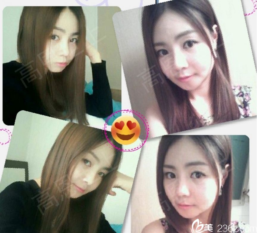 韓國高恩世上整形外科雙眼皮真人<span style=