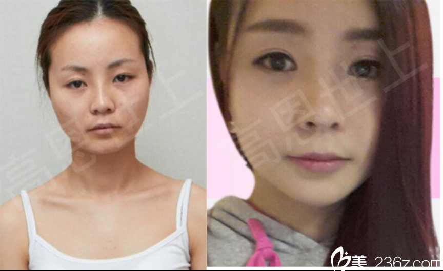 雙眼皮 面部輪廓前后對比