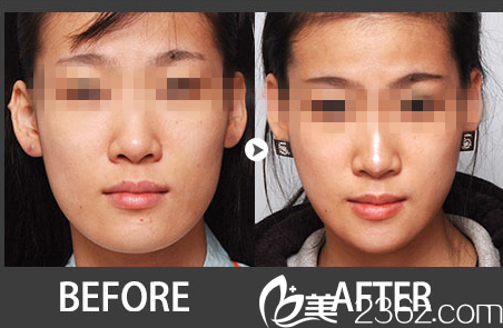 林平珍院長下顎整形真人案例