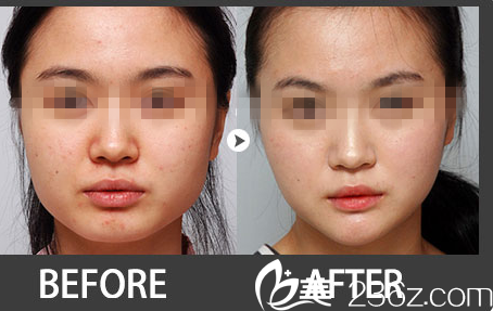 林平珍下顎整形前后