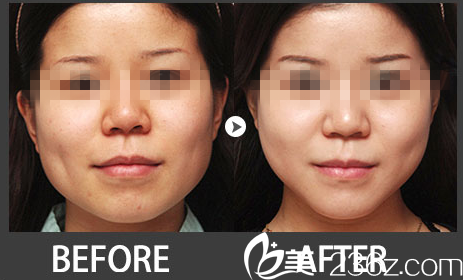 韓國嫵麗整形外科下顎整形對比圖