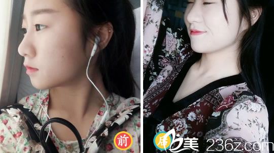 寧波薇琳<!--<i data=20240703-sp></i>-->注射玻尿酸豐下巴案例