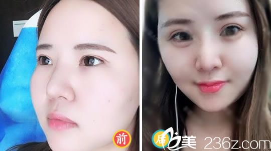 薇琳<!--<i data=20240703-sp></i>-->注射玻尿酸填充臥蠶案例