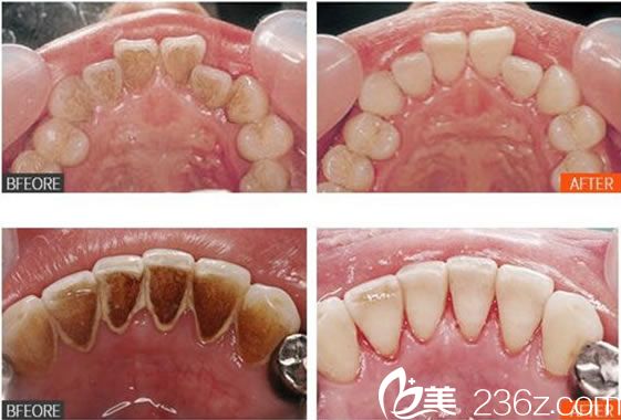 寧波薇琳范國文超聲波潔牙案例