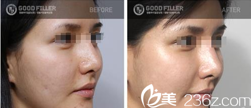 GOOD FILLER整形外科案例