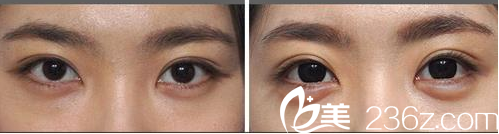 GOOD FILLER整形外科案例