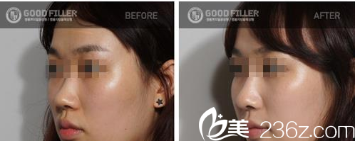 GOOD FILLER整形外科案例