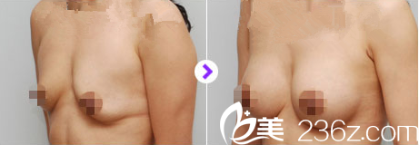 金允石院長(zhǎng)矯正下垂胸部真人案例