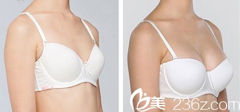 金允石院長(zhǎng)假體隆胸前后對(duì)比圖