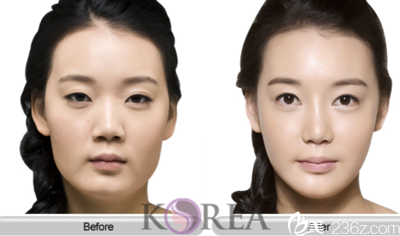 韓國KOREA整形崔相錄院長Vline案例