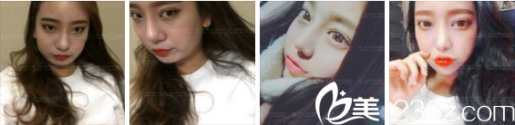 張瑞允院長開眼角+面部輪廓手術(shù)