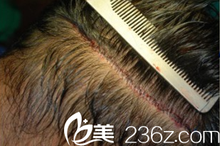 我花15000找韓國(guó)狎鷗亭延世醫(yī)院金大溶做毛發(fā)移植再也不怕娶不到媳婦兒了！