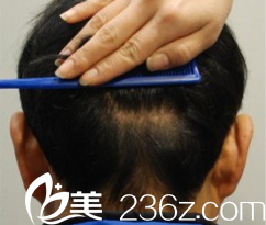 韓國狎鷗亭延世醫(yī)院毛發(fā)移植術(shù)后