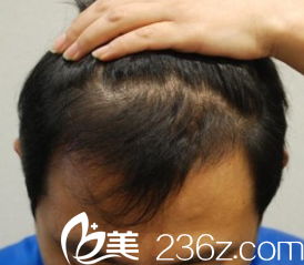 金大溶院長毛發(fā)移植術(shù)后5個月