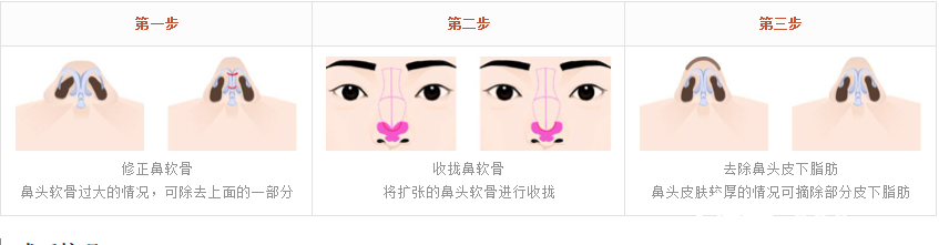 鼻頭軟骨整形手術(shù)過程