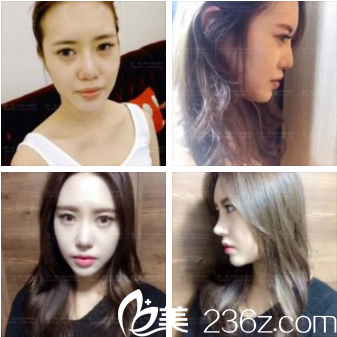 KOREA整形鼻整形案例