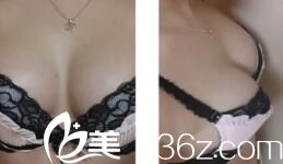 韓國optima整形外科李安娜隆胸效果怎么樣？假體隆胸真人案例