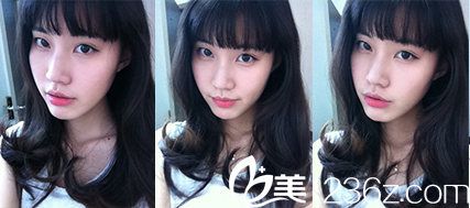 韓國狎鷗亭YK整形外科做面部輪廓怎們樣？真人案例