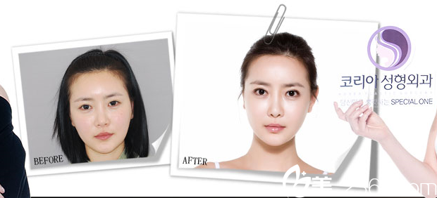 韓國(guó)KOREA整形外科申承翰真人案例